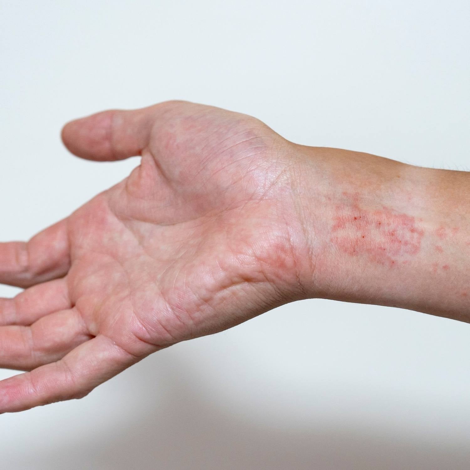 Kontaktallergi - symptomer og behandling