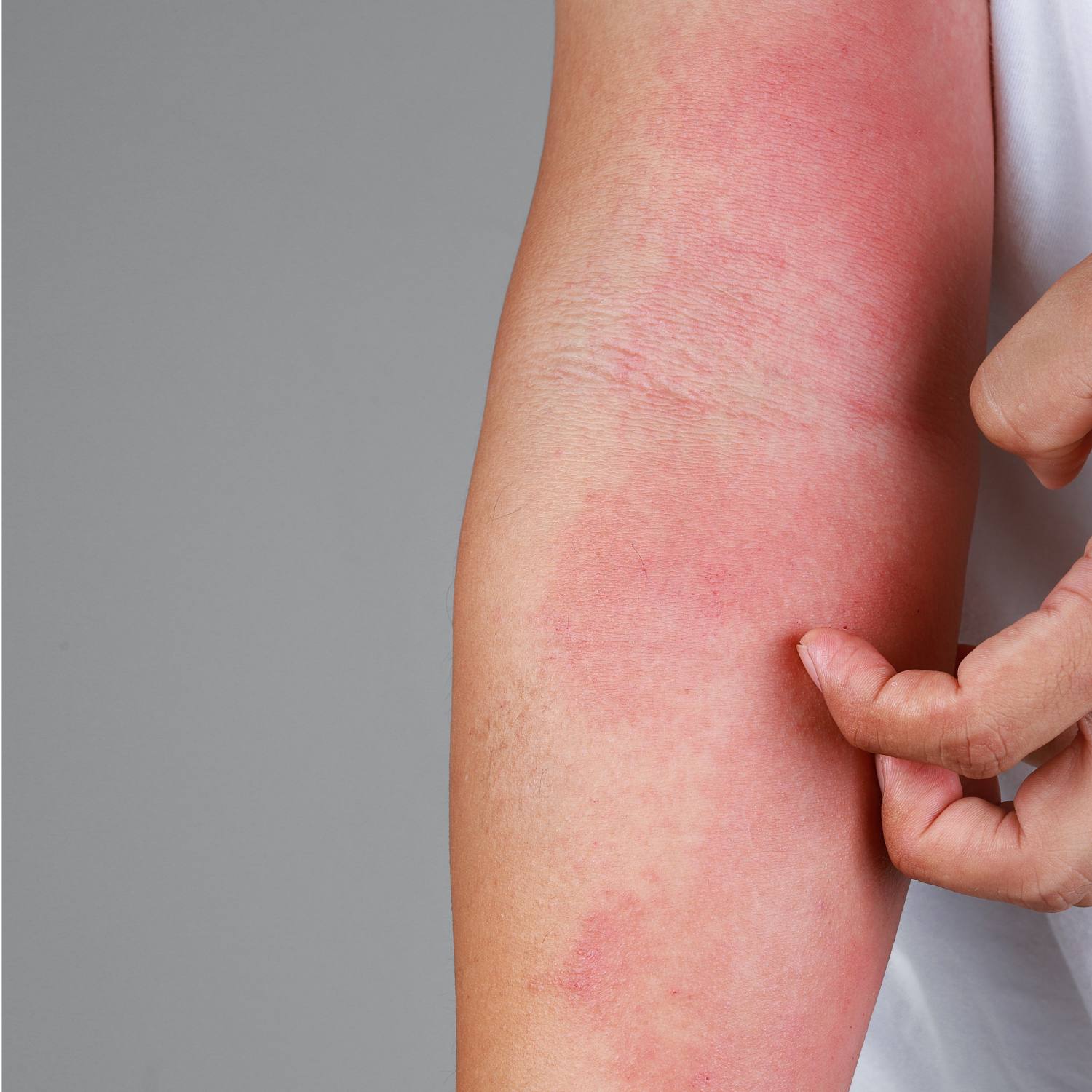 Børneeksem - atopisk eksem