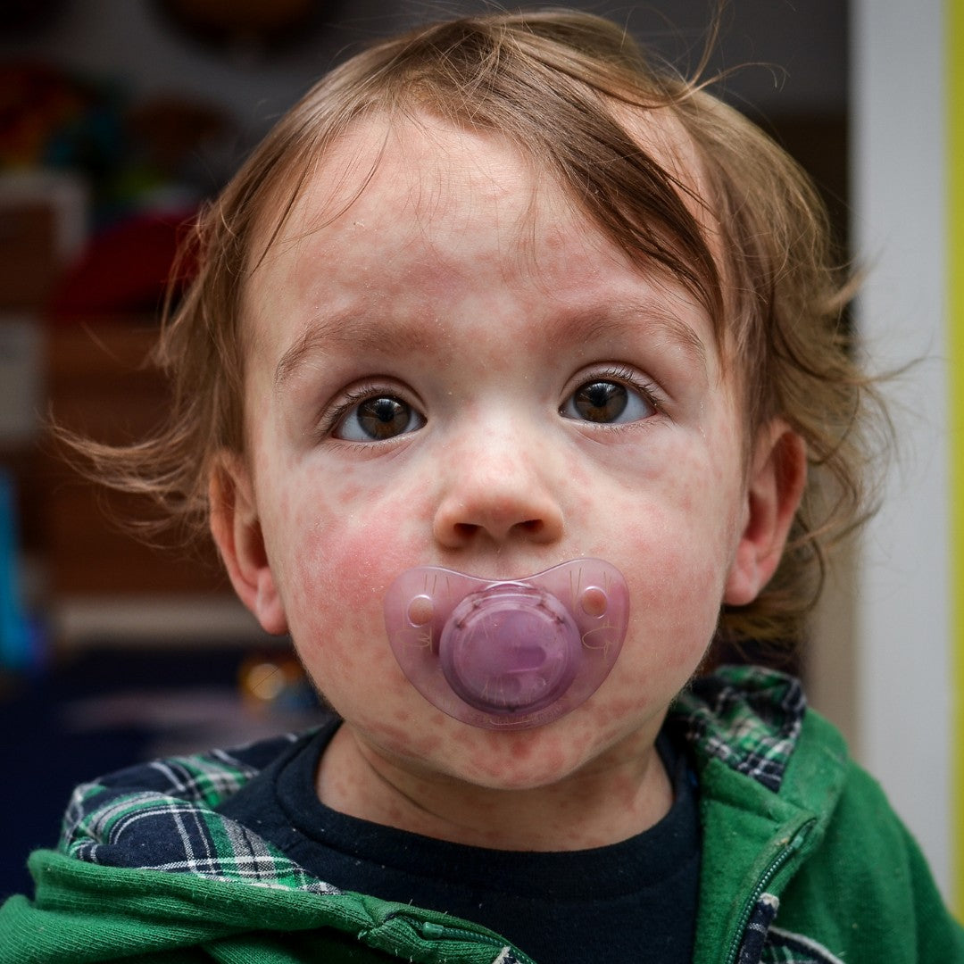 Allergi hos 1- og 2-årig